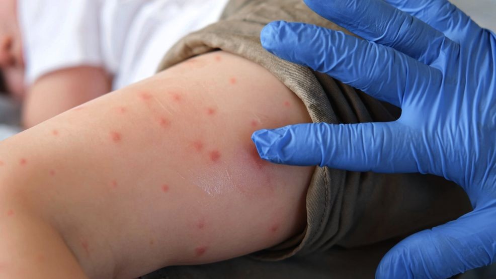 Measles continues to rage in South Carolina; 99 new cases reported since Tuesday